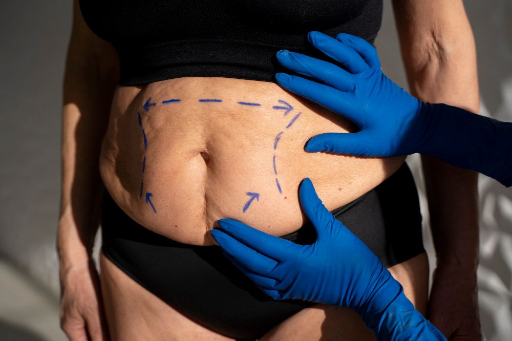 Conoce las etapas de una cirugía plástica de abdomen